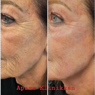 Rett etter første behandling Hifu+Rf nano fractional. 

Dette er en av de beste kombinasjon til å få