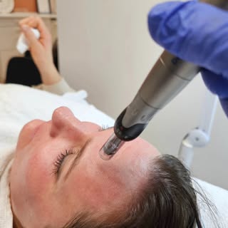 Dermapen behandling  tilbud 1350 kr kun uke 47.