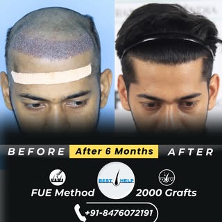 💻 Visit us: www.besthairhelp.com
📞 Call/WhatsApp: +91 8273645677
#HairTransplantResults #HairTrans