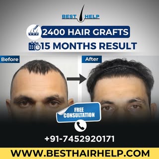 Transforming lives, one hairline at a time. 
💻 Visit us: www.besthairhelp.com
📞 Call/WhatsApp: +91