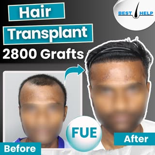 Transforming lives, one hairline at a time. 
💻 Visit us: www.besthairhelp.com
📞 Call/WhatsApp: +91