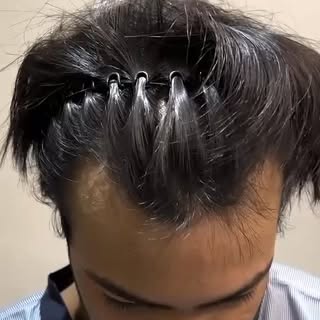 3 Hair Transplant Results Of 1000, 2000 And 3000 Grafts In 1 Minute 🔥🔥🔥

 #hairtransplant #hairtr