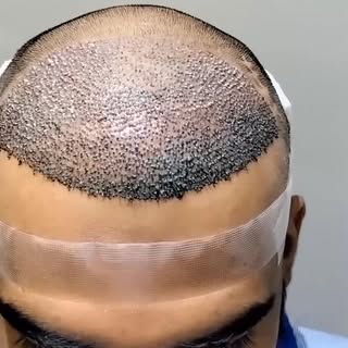 A Failed Hair Transplant Result Caused By Damaged Grafts 🔥🔥🔥 #hairtransplantresults