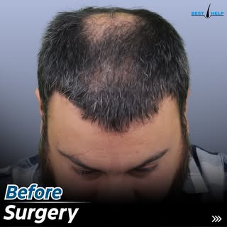 Result after 7 Month
Grafts :  3650
Clinic : IFT Hair Science Clinic in Jaipur
Get Free Hair Transpl