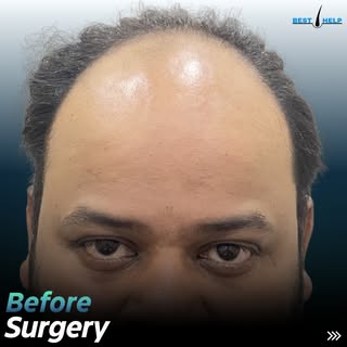 After 7 Months Hair Transplant Result
Grafts :  4530
Clinic : Density Hairtransplant Clinic Ranchi, 