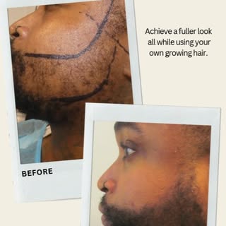 From patchy to powerful.  At HRS, we fill in beards, making it look fuller all while using your own 