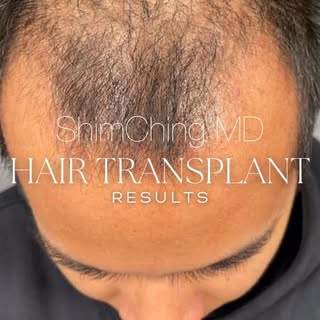 There’s something truly inspiring about watching confidence grow back along with your hair. When a t