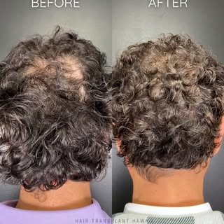 One of the most rewarding parts of our work is seeing how patients light up after their hair is rest