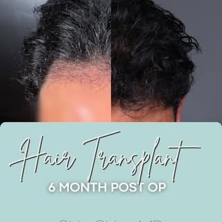 Large FUE Hair Transplant: Front & Top Density Build

This patient came to us with advanced hair thi