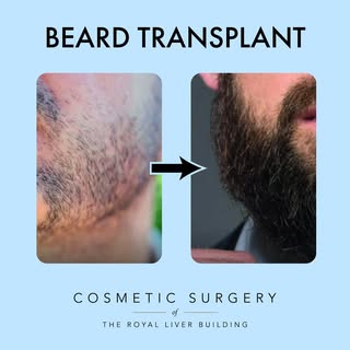 Struggling with uneven facial hair or areas that simply won’t grow? 🧔

A beard transplant offers a 