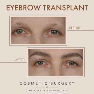 ✨ Wake up with the brows you’ve always wanted. ✨

If over-plucking, genetics, scarring or hair loss 