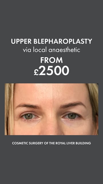 Droopy eyelids? Upper Blepharoplasty could be the solution. ✨

Excess skin on the upper eyelids can 