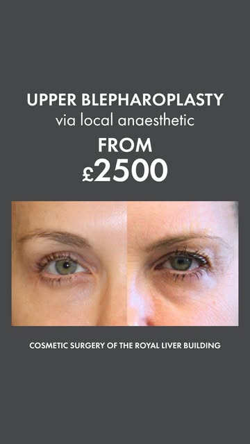 Droopy eyelids? Upper Blepharoplasty could be the solution. ✨

Excess skin on the upper eyelids can 
