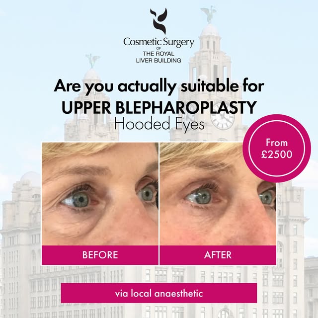 Are you actually suitable for Upper Blepharoplasty? 👁️✨

Hooded eyes 👁️ heavy lids or excess upper