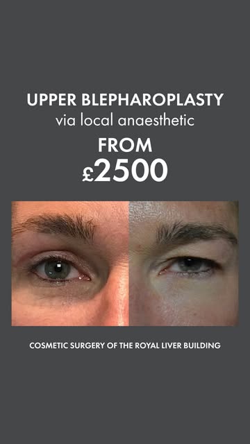 Droopy eyelids? Upper Blepharoplasty could be the solution. ✨

Excess skin on the upper eyelids can 