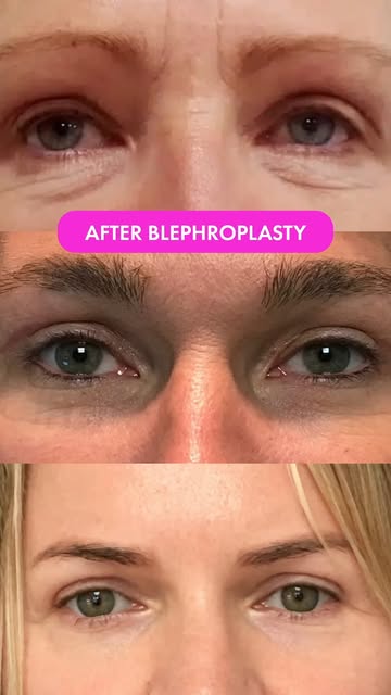 👁️ A subtle change. A refreshed look.

This before-and-after shows the result of Upper Blepharoplas