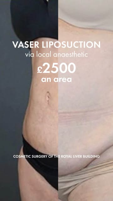 Targeting stubborn areas that don’t respond to diet and training with VASER liposuction for precise,