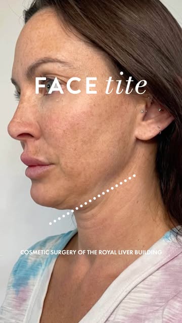 Experience a more sculpted, defined look with FaceTite ✨
This minimally invasive treatment tightens 