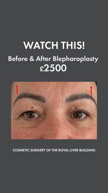 WATCH THIS TRANSFORMATION 👁️✨

A subtle change that can make a noticeable difference.

This before-