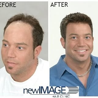 iHair is a non-surgical hair replacement for men offered exclusively at New Image Hair Clinic. The i