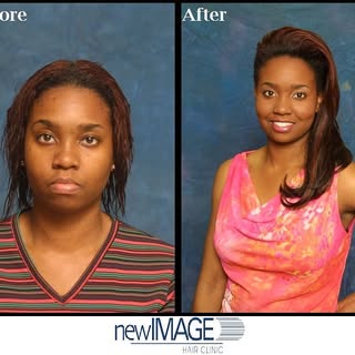 Looking beautiful and feeling young matters. Thinning hair and hair loss in women can be devastating