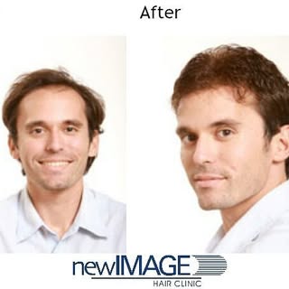 Hair implants for men can have results as natural as hair transplantation, without the surgery. This