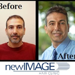 Our hair transplant procedure combines experienced surgical skills and artistry to recreate the hair