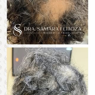 Alopecia areata é desencadeada pelo estresse emocional! 

Cuide-se