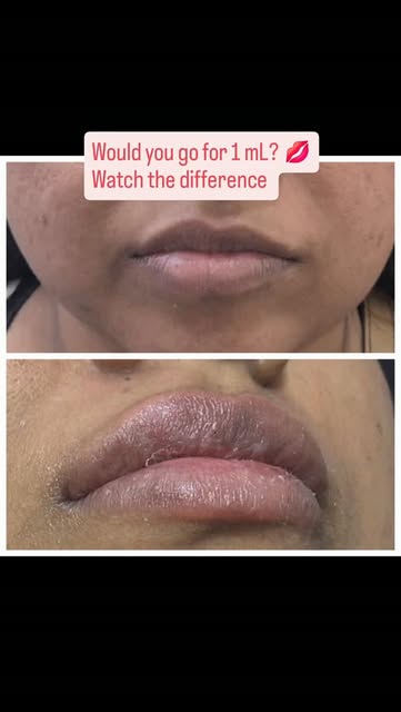Just 1 mL. But what a difference! 💋

Sometimes, you don’t need a dramatic change—you just need the 