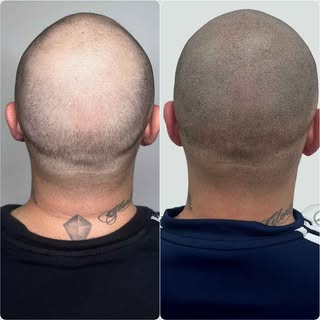 Este es uno de nuestros pacientes que quería un look rapado definido y natural. Con la micropigmenta