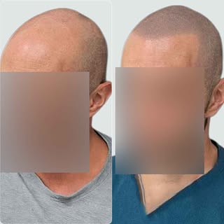 Este paciente quería recuperar una línea frontal que se viera natural, como la que tenía años atrás.