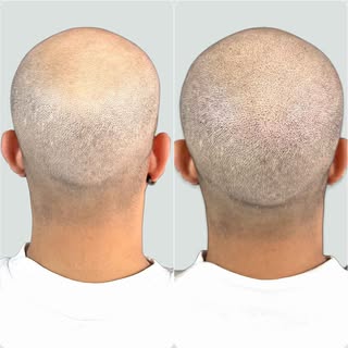 Otro de nuestros antes y después ¿Qué os parece este trabajo de micropigmentación tapando esas zonas