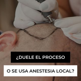 💉 ¿Duele un injerto capilar?
No, el procedimiento no duele, ya que se utiliza anestesia local en el