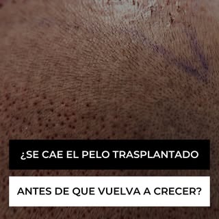 🧑‍🦲💬 ¿Se cae el cabello trasplantado antes de que vuelva a crecer?
¡Sí, puede pasar y es completa