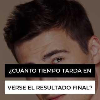 🕒 ¿Cuándo se ve el resultado final de un injerto capilar?

A partir de los 2 a 3 meses el cabello c