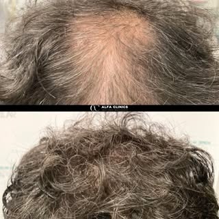 💇‍♂️ Antes y después que impacta 🔥

Mira cómo un injerto capilar puede transformar la densidad y n