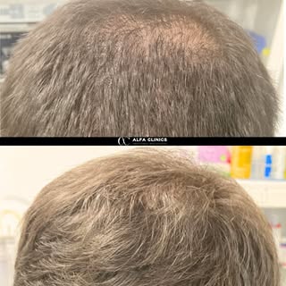 Recuperar tu cabello es posible y este resultado lo demuestra. 🙌 Con nuestro injerto capilar, logra