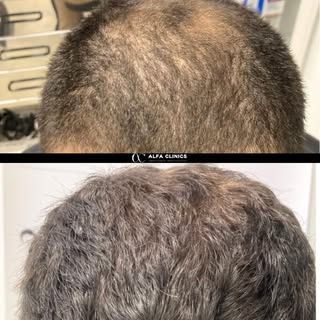 💇‍♂️ ¡Dale a tu cabello una segunda oportunidad! 🔥

Esta transformación es la prueba de que un inj