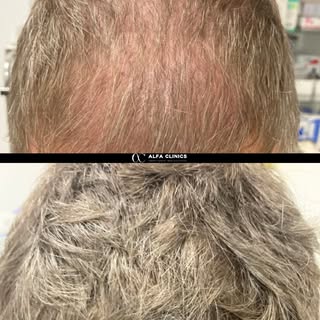 💇‍♂️ Transformación real, confianza renovada 🔥

Recuperar tu cabello con un injerto capilar nunca 
