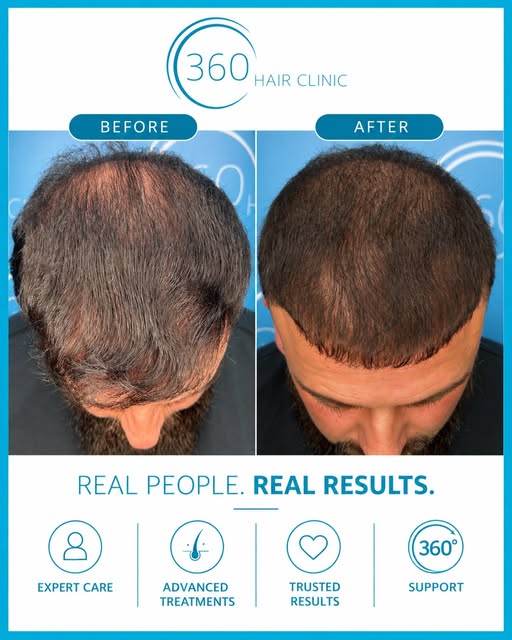 Just 2 months into his hair loss treatment journey and we’re already seeing encouraging progress 🙌�