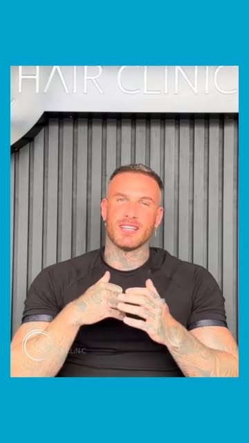 ⭐️ Warren’s experience with 360 Hair Clinic

When Warren came to us, he had already undergone two ha