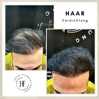 ⚜️ Haarpigmentierung-Freiburg ⚜️

Wenn Sie unter Haarausfall, Geheimratsecken, undichten Haaren, Nar