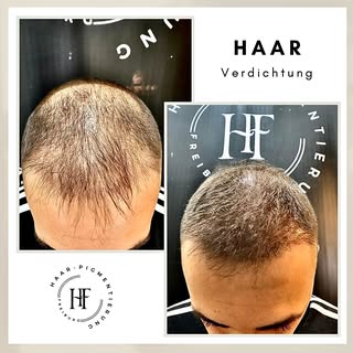 ⚜️ Haarpigmentierung-Freiburg ⚜️

Wenn Sie unter Haarausfall, Geheimratsecken, undichten Haaren, Nar