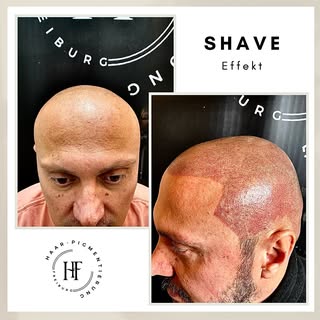 ⚜️ Haarpigmentierung-Freiburg ⚜️

Wenn Sie unter Haarausfall, Geheimratsecken, undichten Haaren, Nar