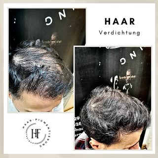 ⚜️ Haarpigmentierung-Freiburg ⚜️

Wenn Sie unter Haarausfall, Geheimratsecken, undichten Haaren, Nar