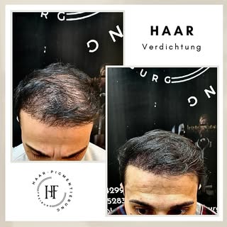⚜️ Haarpigmentierung-Freiburg ⚜️

Wenn Sie unter Haarausfall, Geheimratsecken, undichten Haaren, Nar