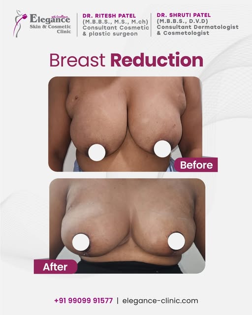 Breast reduction surgery can help achieve improved comfort, body balance, and confidence with expert