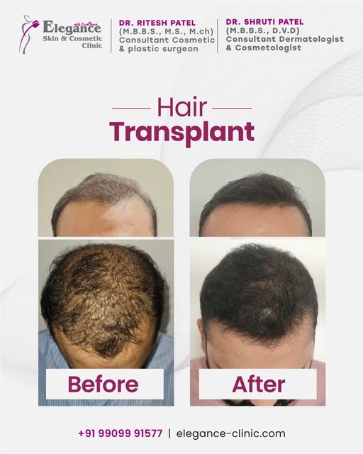 Restore fuller-looking hair with expert hair transplant treatment in Ahmedabad, planned for natural-