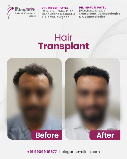 Restore confidence with advanced hair transplant solutions designed for a natural-looking hairline a