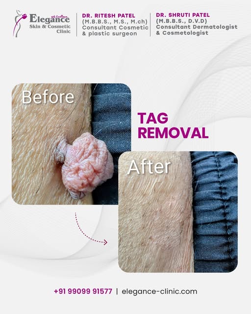 Say goodbye to unwanted skin tags with safe and precise tag removal treatment by expert dermatologis
